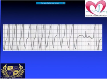 SVT with aberrancy vs VT with examples