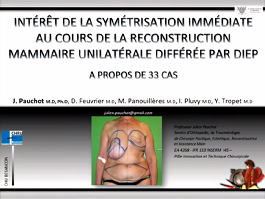 Symétrisation immédiate au cours de la reconstruction mammaire unilatérale différée par DIEP Symétrisation immédiate au cours de la reconstruction mammaire unilatérale différée par DIEP