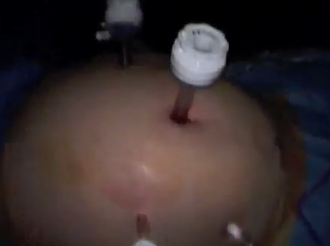 Synchronous Laparoscopic Right Colectomy and Rectal Resection.