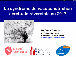 Syndrome de vasoconstriction cérébrale Syndrome de vasoconstriction cérébrale