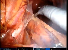 Tailored Robotic Abdominoperineal Resection for Rectal Tumor Regrowth after Complete Response Tailored Robotic Abdominoperineal Resection for Rectal Tumor Regrowth after Complete Response
