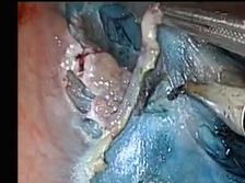 TAMIS-ESD/EMR Excision of Circumferential LST-G Polyp in Mid and Upper Rectum. TAMIS-ESD/EMR Excision of Circumferential LST-G Polyp in Mid and Upper Rectum.