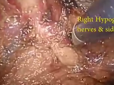 taTME- Excision of Denonvilliers Fascia in Anterior Rectal Tumours