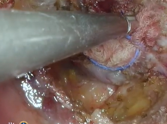 TaTME for the treatment of advanced rectal cancer