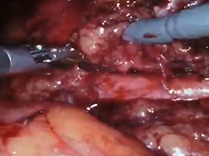 Technical considerations for a horseshoe kidney and a posteriorly occurring renal Technical considerations for a horseshoe kidney and a posteriorly occurring renal