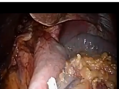 Technical Considerations In Single Incision Paraesophageal Surgery