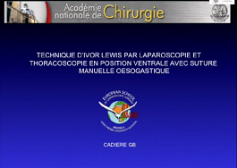 Technique d'Ivor Lewis par laparoscopie et thoracoscopie en position ventrale avec suture manuelle oesogastrique Technique d'Ivor Lewis par laparoscopie et thoracoscopie en position ventrale avec suture manuelle oesogastrique