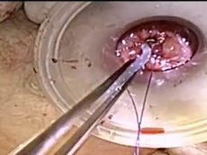 Technique for a stapled anastomosis following transanal total mesorectal excision (taTME). Technique for a stapled anastomosis following transanal total mesorectal excision (taTME).