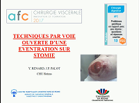 Technique par voie ouverte d'une éventration sur stomie