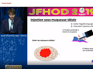 Techniques de soulèvement des polypes du côlon