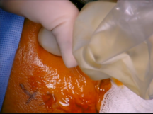 Temporal Artery Biopsy Temporal Artery Biopsy