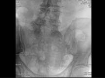 TEVAR Using Conformable Thoracic Stent Graft with Active Control System TEVAR Using Conformable Thoracic Stent Graft with Active Control System