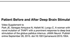 THAP1 Mutation With Prominent Response to Deep Brain Stimulation THAP1 Mutation With Prominent Response to Deep Brain Stimulation