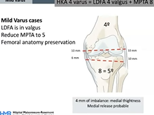 The 5 principles to perform restricted kinematic alignment total knee arthroplasty The 5 principles to perform restricted kinematic alignment total knee arthroplasty
