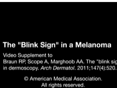 The "Blink Sign" in Dermoscopy 1