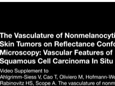 The "Blink Sign" in Dermoscopy 2