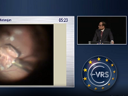 The Claw  A Novel Intraocular Foreign Body Removal Forceps