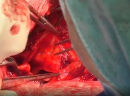 The David procedure for surgical management of neo-aortic root dilatation