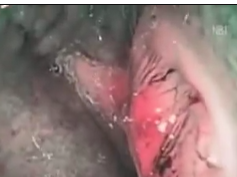 The Endoscopic Appearance of Tumor Under Narrowband Imaging