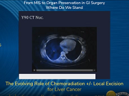 The Evolving Role of Chemoradiation +/- Local Excision for Liver Cancer