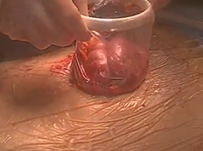 The final twist: the use of a wound protector in reducing an extracorporeal anastomosis. The final twist: the use of a wound protector in reducing an extracorporeal anastomosis.