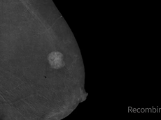 The Images Stack Up  SenoBright HD Contrast-Enhanced Spectral Mammography The Images Stack Up  SenoBright HD Contrast-Enhanced Spectral Mammography
