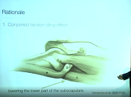 The Latarjet procedure: Why is it good for athletes? The Latarjet procedure: Why is it good for athletes?