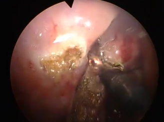 The Limits of TEM and Beyond