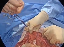 The Lipo-Body Lift: Game Changing Early Research