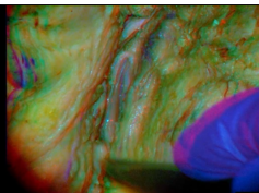 The Postauricular Transtemporal Approach to the Jugular Foramen (3D Anaglyph)