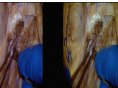 The Postauricular Transtemporal Approach to the Jugular Foramen (3D TV)