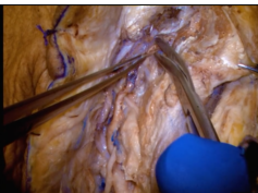 The Postauricular Transtemporal Approach to the Jugular Foramen
