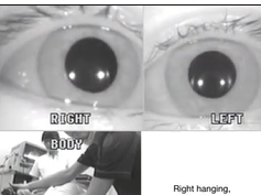 The Presence of Nystagmus Suggests a Canalith Jam of the Horizontal Semicircular Canal on the Right The Presence of Nystagmus Suggests a Canalith Jam of the Horizontal Semicircular Canal on the Right