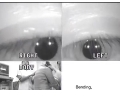 The Presence of Nystagmus Suggests Geotropic Variant of Horizontal Semicircular Canal Benign Paroxys The Presence of Nystagmus Suggests Geotropic Variant of Horizontal Semicircular Canal Benign Paroxys