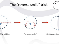 The Reverse Smile Trick: How to Transform a Double-stapled into a Single-stapled Anastomosis. The Reverse Smile Trick: How to Transform a Double-stapled into a Single-stapled Anastomosis.