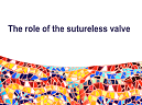 The role of the sutureless valve - 30 th EACTS 2016 The role of the sutureless valve - 30 th EACTS 2016