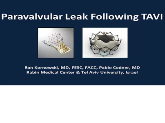 The Significance and How to Minimize Aortic Regurgitation after TAVI?