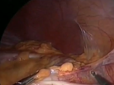 The Three Approaches to Laparoscopic Colonic Splenic Flexure Mobilisation