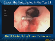 The Unlooked for of Lower Endoscopy