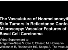 The Vasculature of Nonmelanocytic Skin Tumors in Reflectance Confocal Microscopy, II: Vascular Featu -3