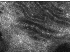 The Vasculature of Nonmelanocytic Skin Tumors in Reflectance Confocal Microscopy, II: Vascular Featu -4