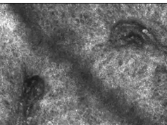 The Vasculature of Nonmelanocytic Skin Tumors on Reflectance Confocal Microscopy: Vascular Features -2