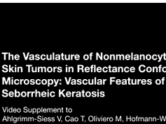 The Vasculature of Nonmelanocytic Skin Tumors on Reflectance Confocal Microscopy: Vascular Features The Vasculature of Nonmelanocytic Skin Tumors on Reflectance Confocal Microscopy: Vascular Features