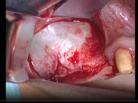 Thin wall sinus antrostomy preparation