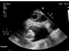Thoracic Aortic Aneurysm Compression of the Left Ventricle