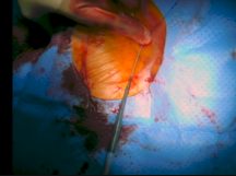 Thoracic Endovascular Repair of Contained Rupture Descending Thoracic Aorta Thoracic Endovascular Repair of Contained Rupture Descending Thoracic Aorta