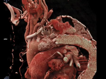 Thoracic Endovascular Repair of Rapidly Expanding False Lumen of Chronic Type III Aortic Dissection Thoracic Endovascular Repair of Rapidly Expanding False Lumen of Chronic Type III Aortic Dissection