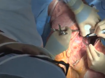 Thoracoabdominal Exposure (Marvin Atkins, MD, and Edward Andraos, MD) Thoracoabdominal Exposure (Marvin Atkins, MD, and Edward Andraos, MD)