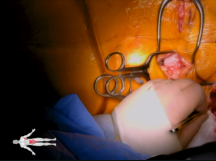 Thoracofemoral Bypass Thoracofemoral Bypass