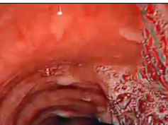 Three-Dimensional Endoscopy